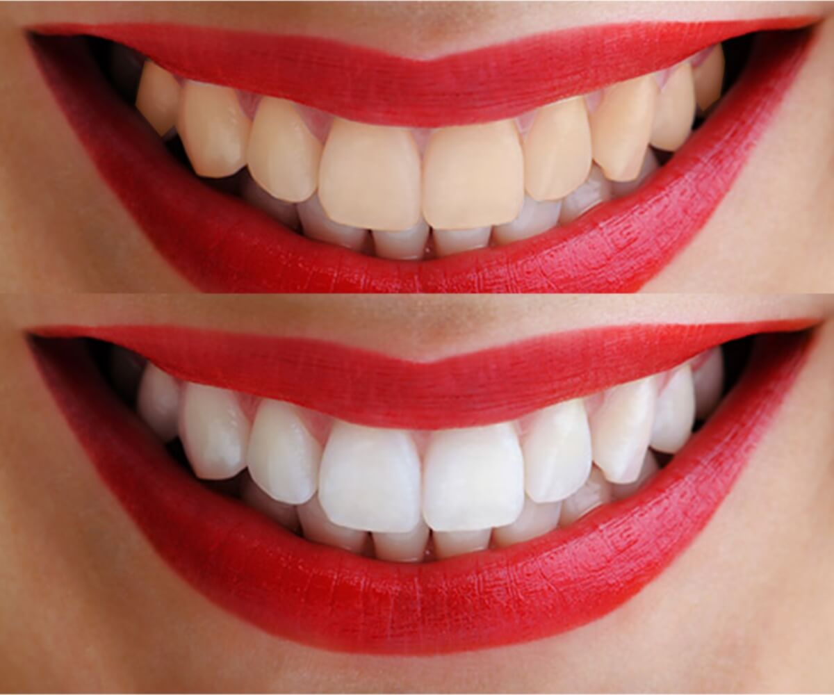 Blanqueamiento Dental