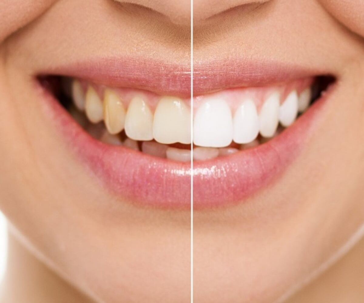 Sonrisa de muejr que muestra un comparativo con su Blanqueamiento Dental en Maxia