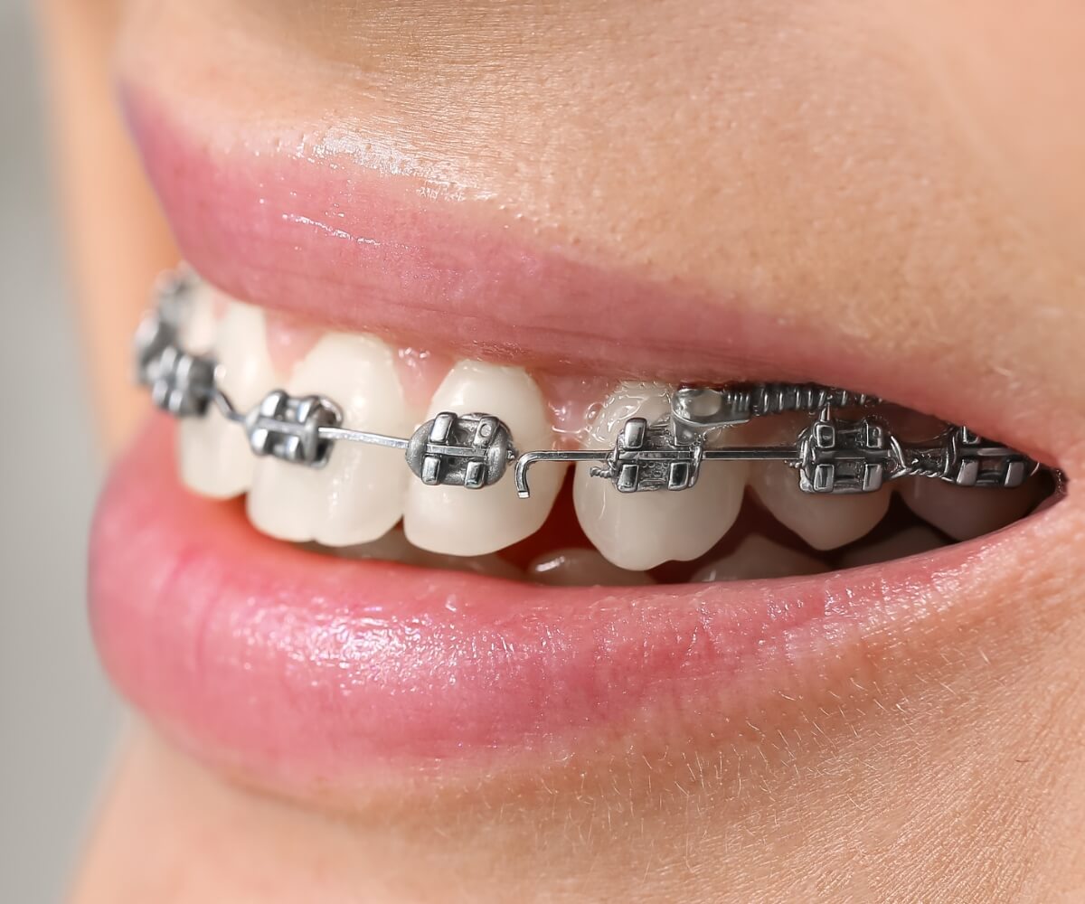 Brackets metálicos convencionales Brackets metálicos convencionales