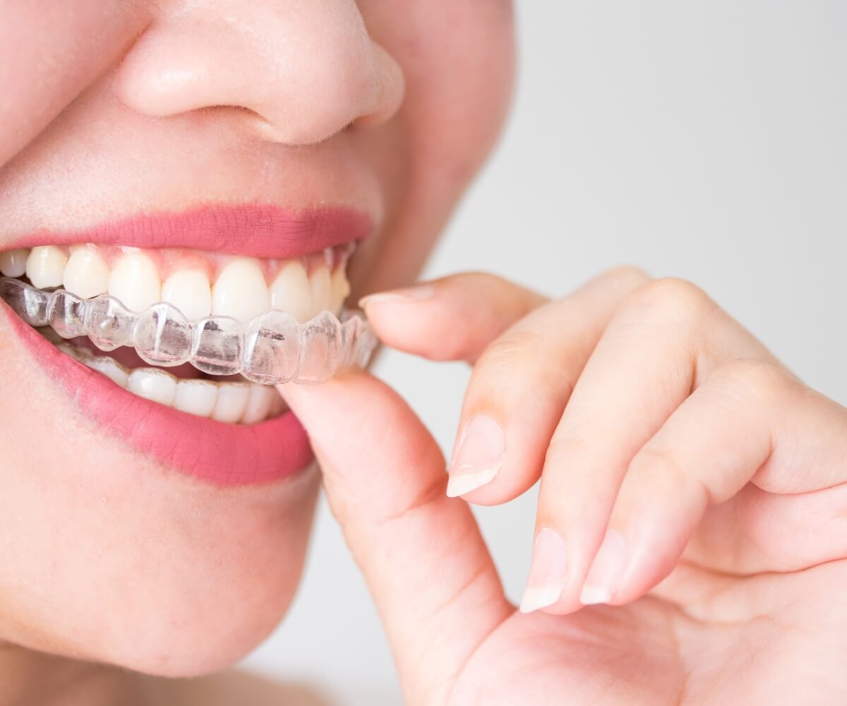 Mujer con Ortodoncia Invisible Invisalign en Maxia